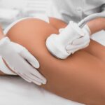 Ultrasound Liposuction All You Need To Know
